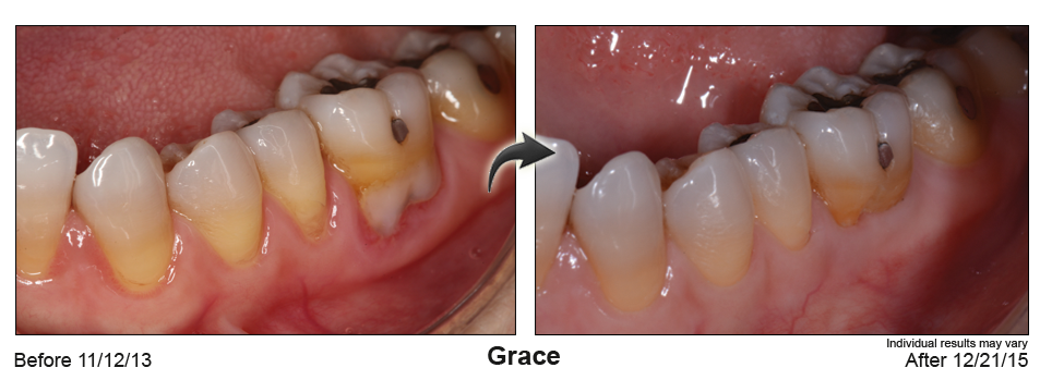 fix gum recession Green Bay Wisconsin