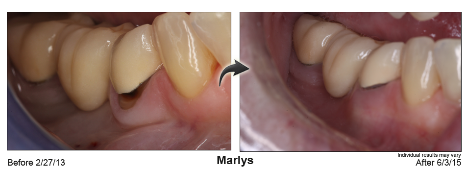 fix receding gums Green Bay Wisconsin