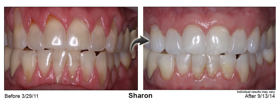 gum recession treatment Green Bay Wisconsin